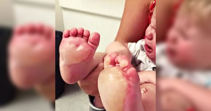 Babá se irrita com bebê de 6 meses e queima seus pés em frigideira quente